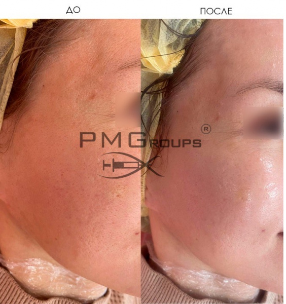 Двухфазный желтый пилинг Philosophy Mezoretin Renewal 365 Pre Peel Yellow, 14 мл